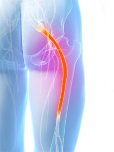 sciatic nerve highlighted