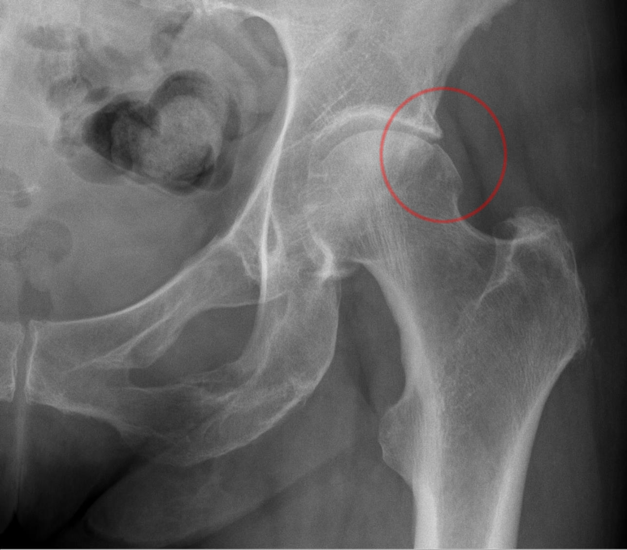 xray of a normal right hip